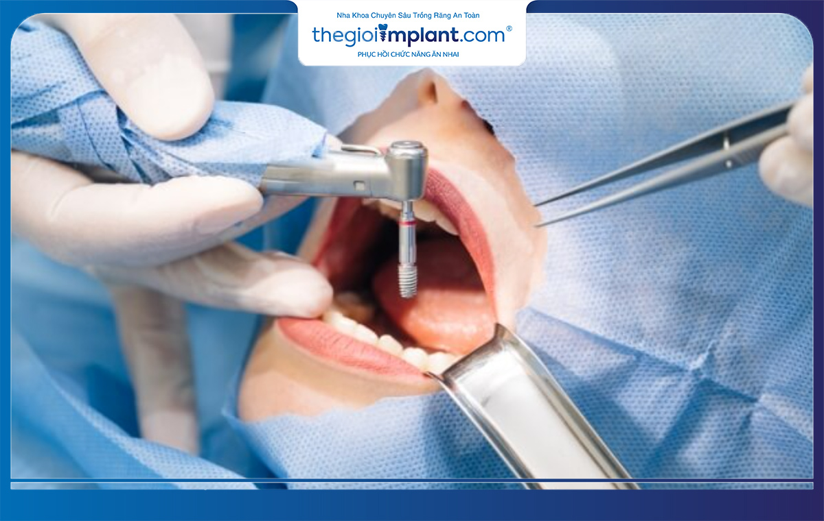 Tiến hành phẫu thuật trồng răng implant