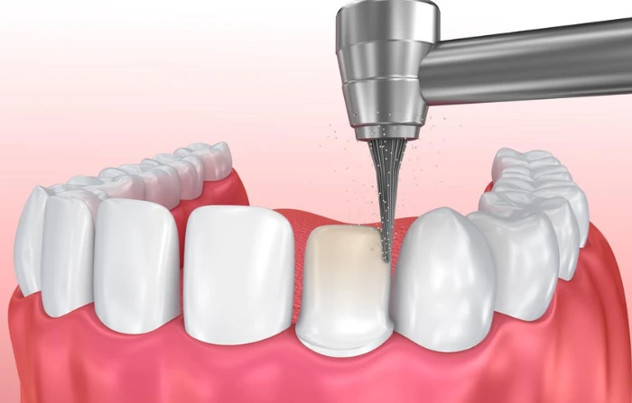 Thế Giới Implant