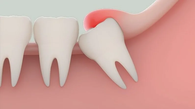 Thế Giới Implant