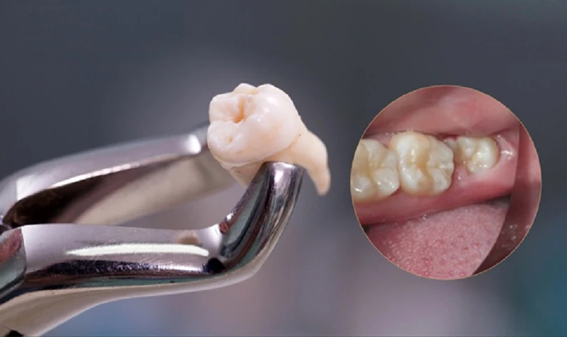Thế Giới Implant