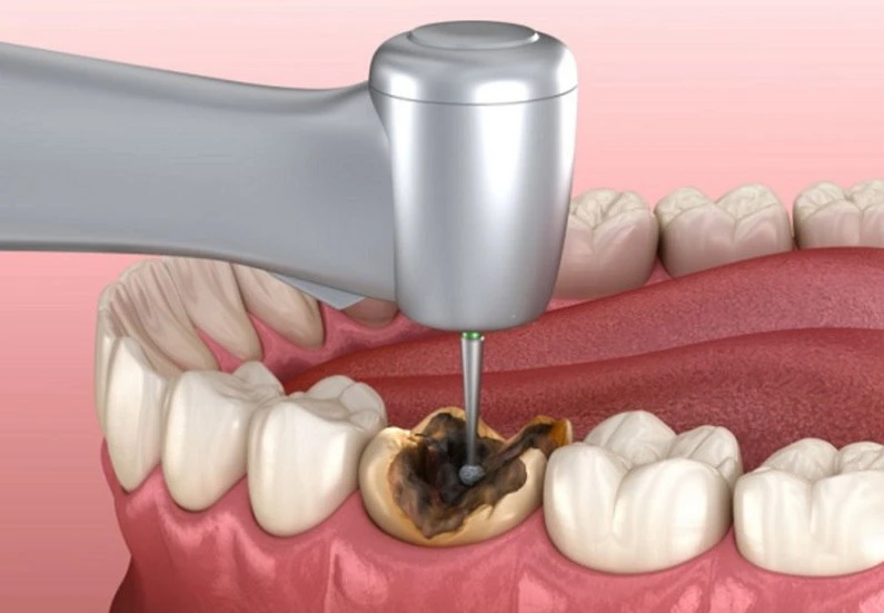 Thế Giới Implant