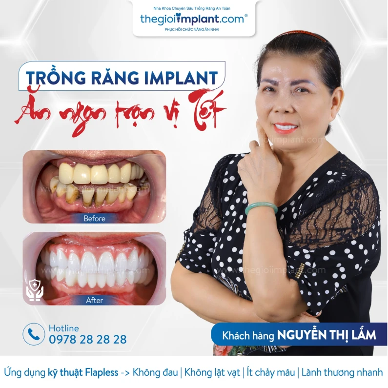 Thế Giới Implant