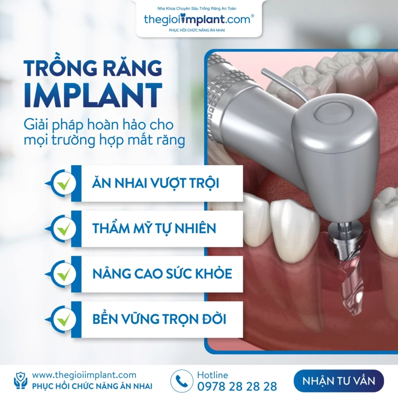 Thế Giới Implant