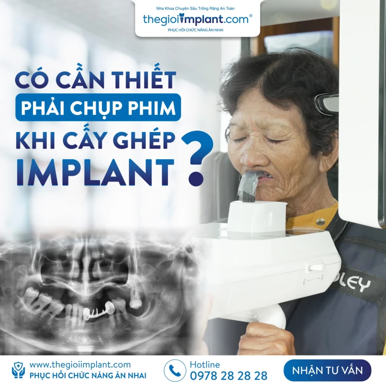 Thế Giới Implant