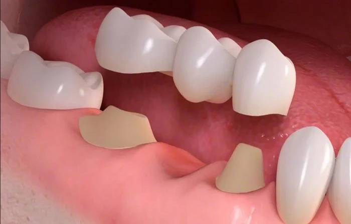 Làm thế nào để trồng răng sứ không có chân răng?