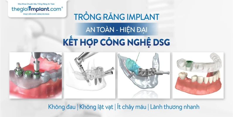 Thế Giới Implant