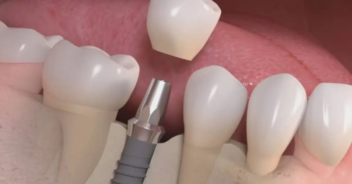 Thế Giới Implant