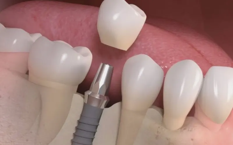 Thế Giới Implant