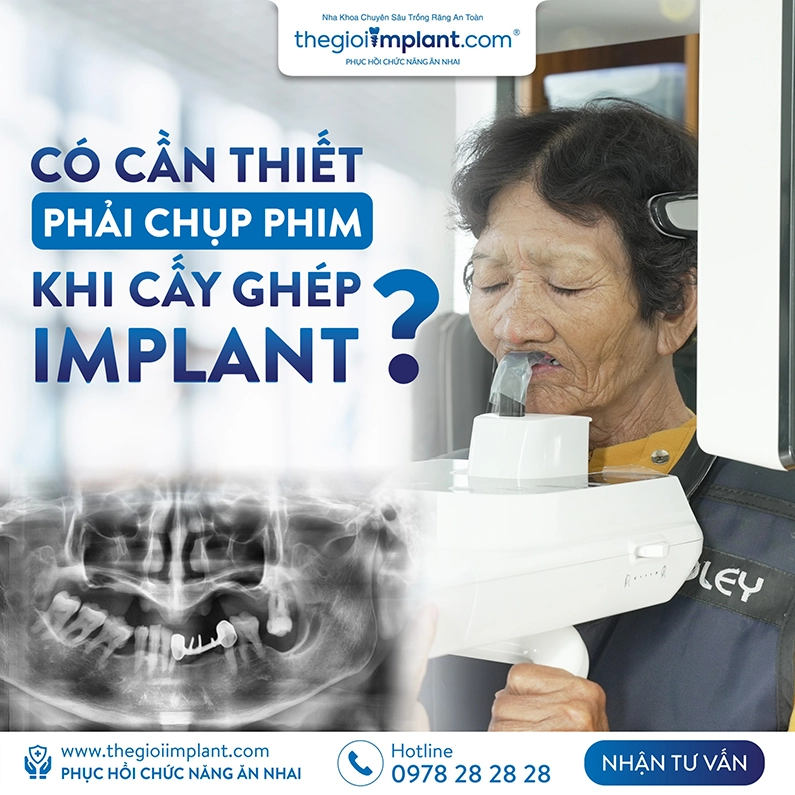 Thế Giới Implant