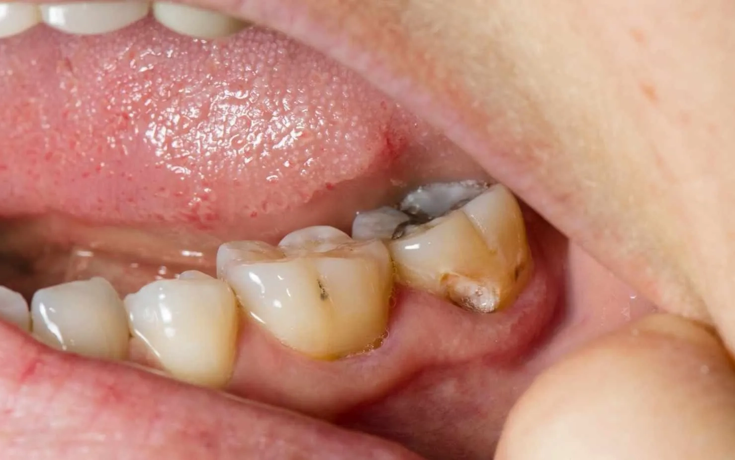 Thế Giới Implant