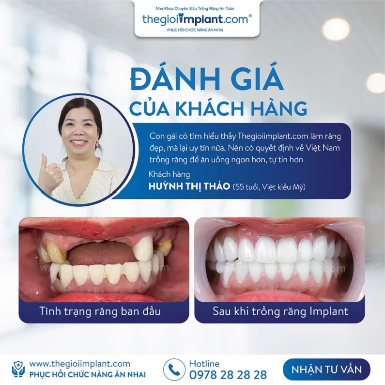 Thế Giới Implant
