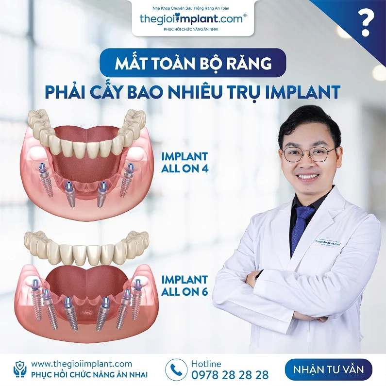 Thế Giới Implant