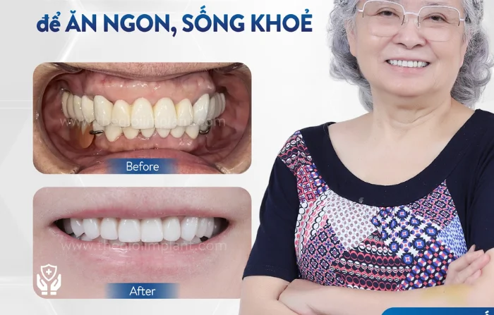 Thế Giới Implant