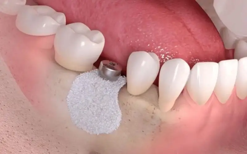 Thế Giới Implant