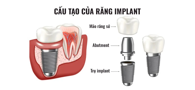Thế Giới Implant