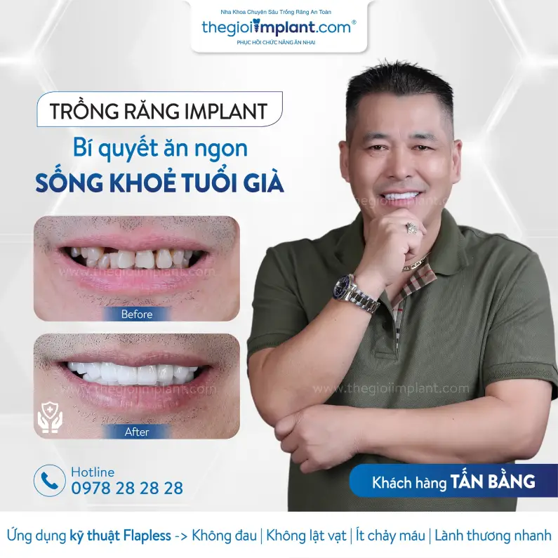 Thế Giới Implant