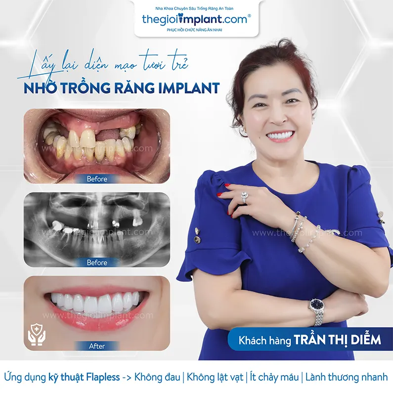 Thế Giới Implant