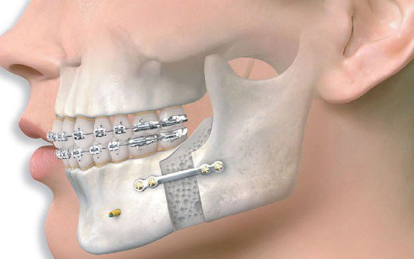 Thế Giới Implant