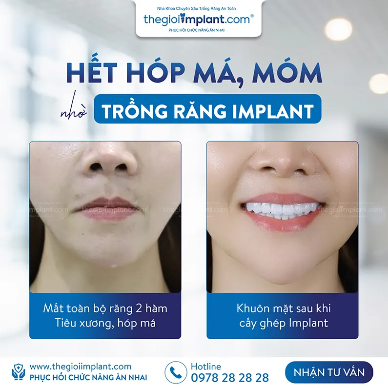 Thế Giới Implant