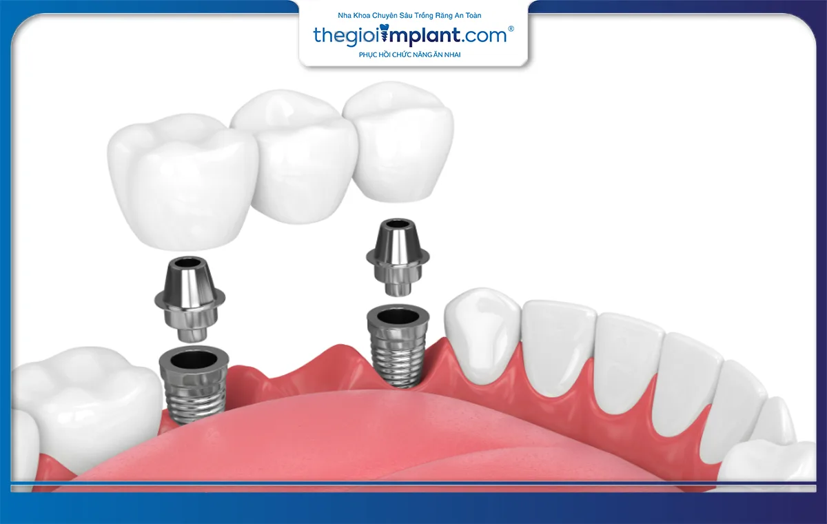 Cấy ghép implant - kỹ thuật phục hình răng tiên tiến hiện nay