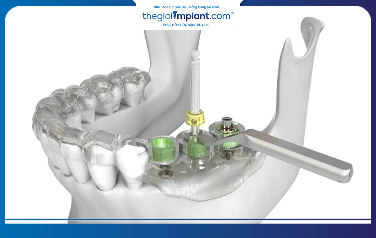 Công nghệ máng định vị DSG tại nha khoa thegioiimplant