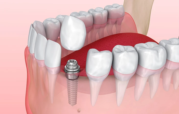 Nhược điểm của trồng răng implant mà bạn cần biết