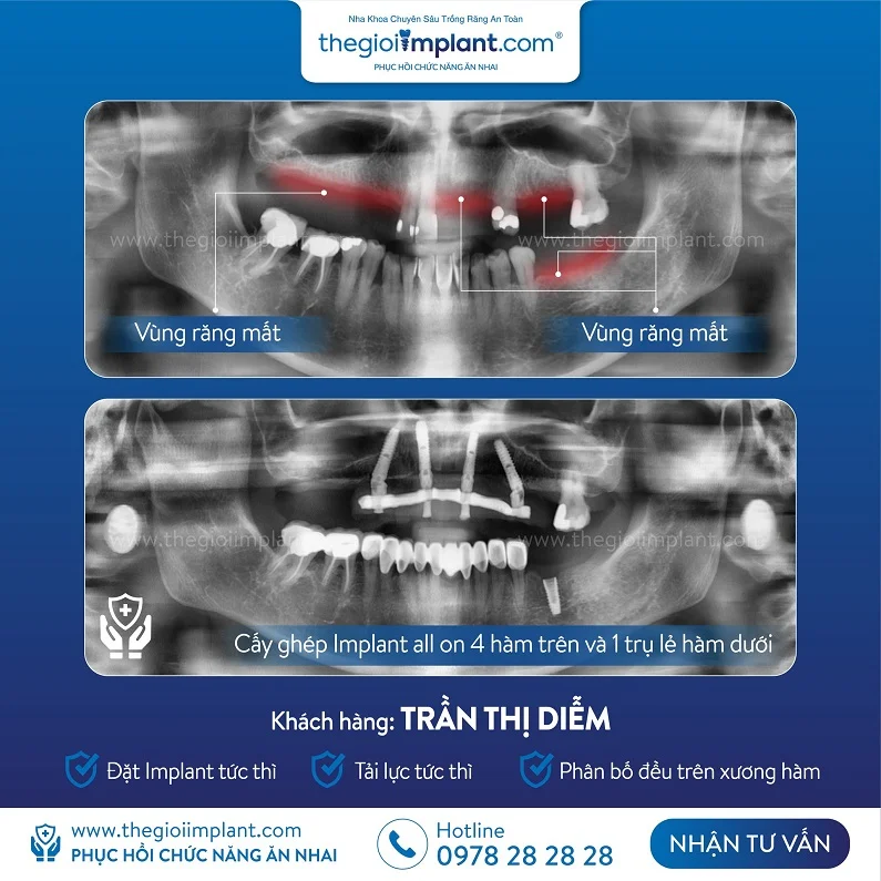 Thế Giới Implant