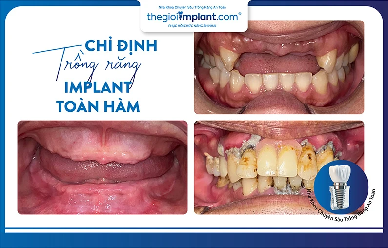 Thế Giới Implant