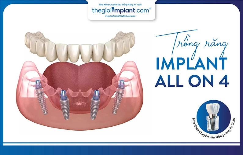 Thế Giới Implant