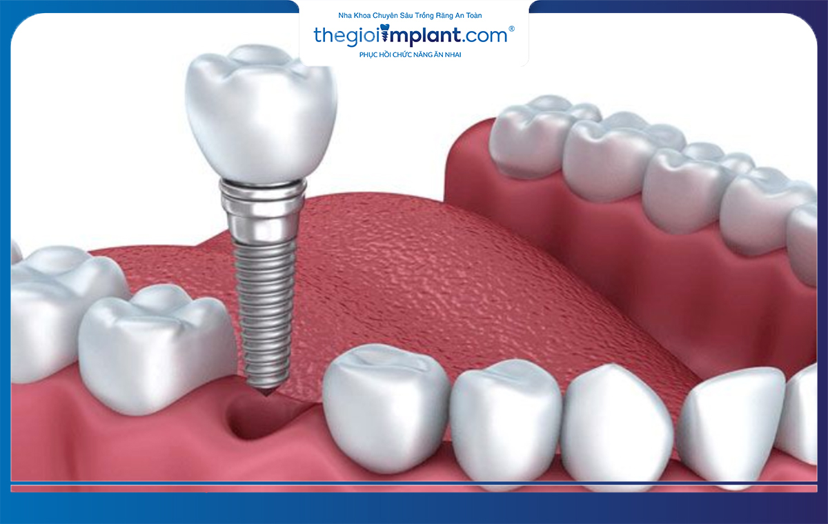 Trồng răng implant là kỹ thuật phục hình răng mất tốt nhất hiện nay