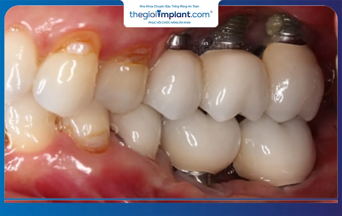 Biến chứng khi sử dụng trụ implant kém chất lượng