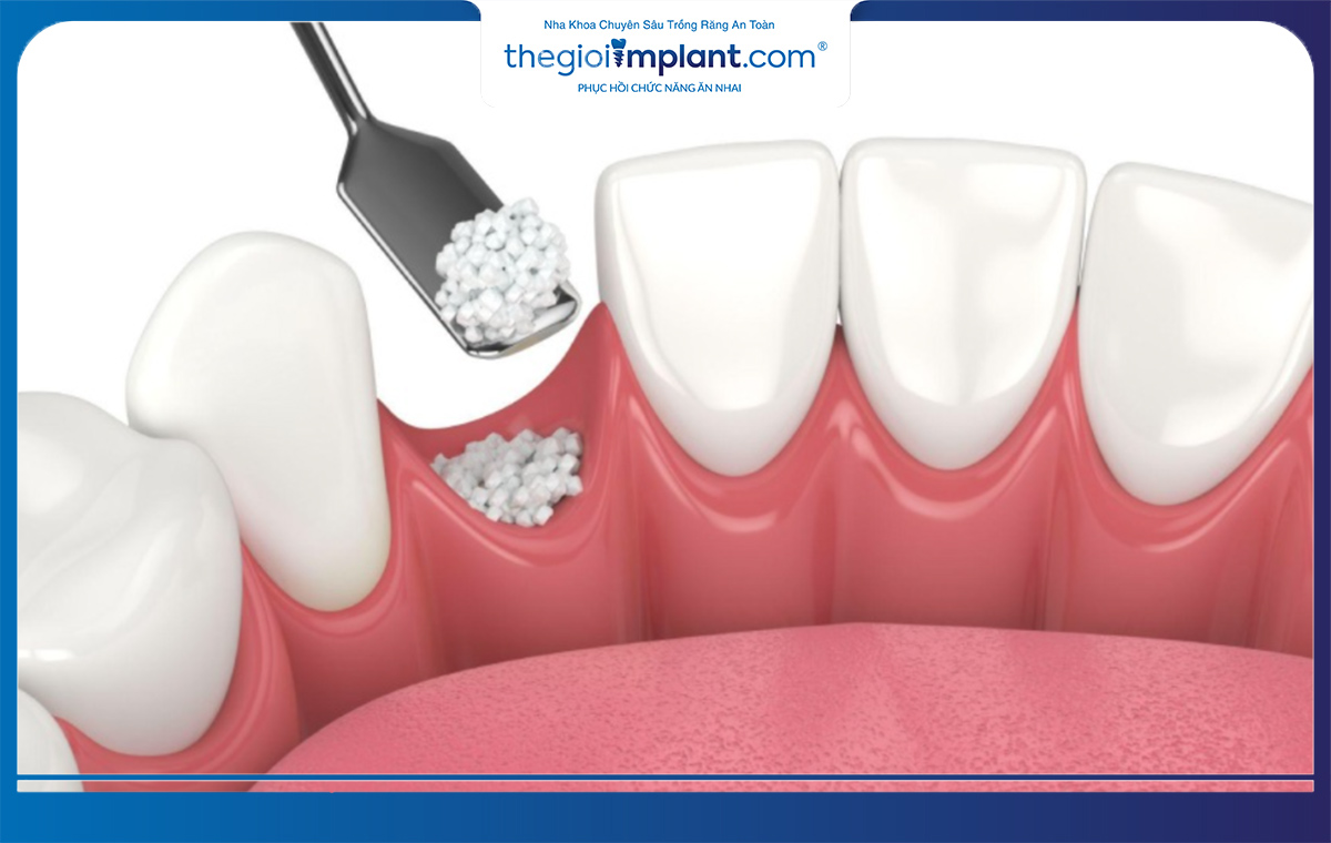 Trường hợp xương hàm bị tiêu nhiều cần thực hiện ghép thêm xương để có thể trồng răng implant