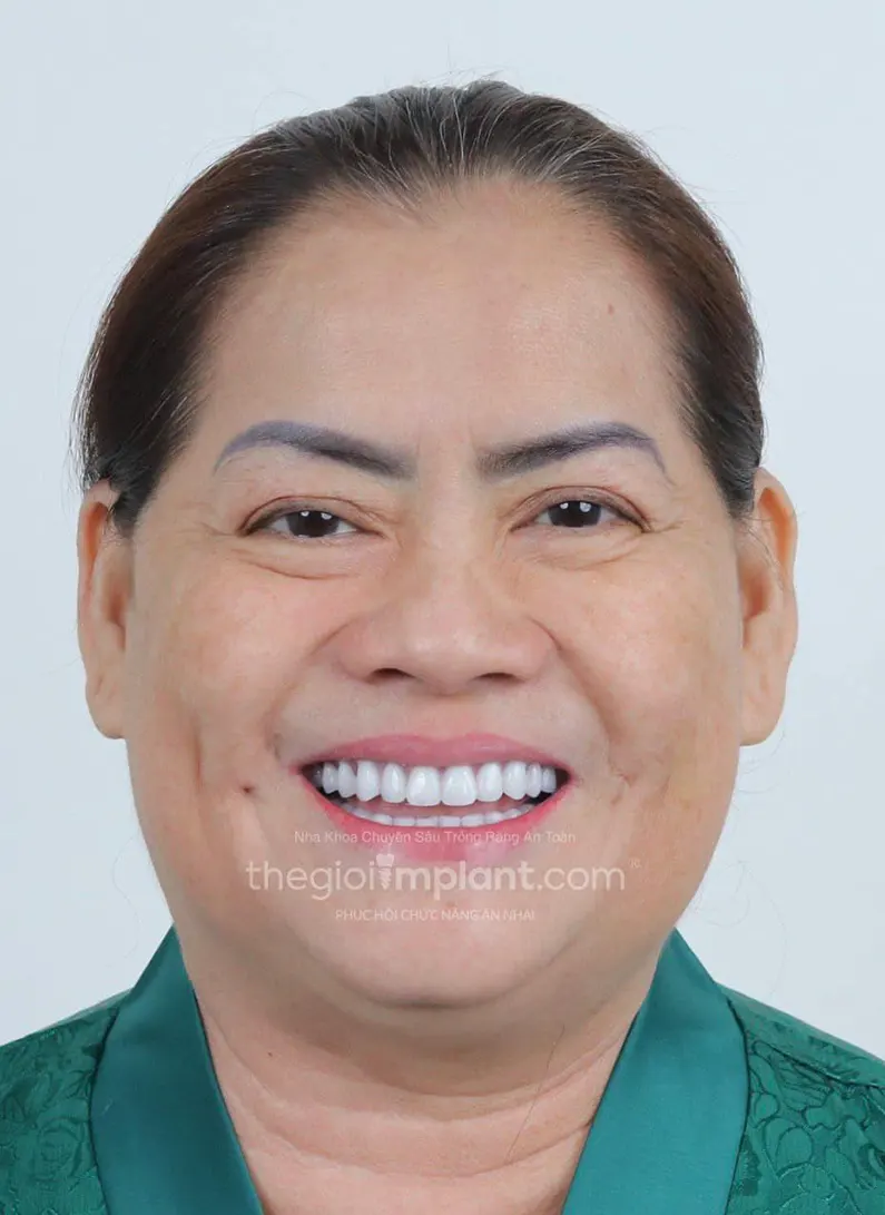 Thế Giới Implant