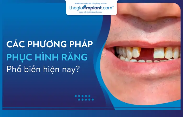 Các phương pháp phục hình răng phổ biến hiện nay?