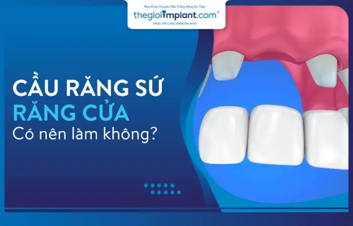 Có nên làm cầu răng sứ răng cửa hay không?