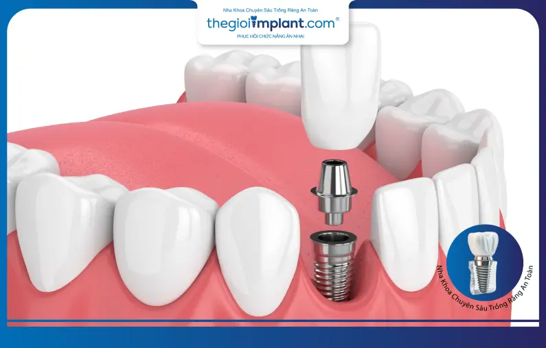 Những điều cần biết trước khi cấy Implant răng cửa