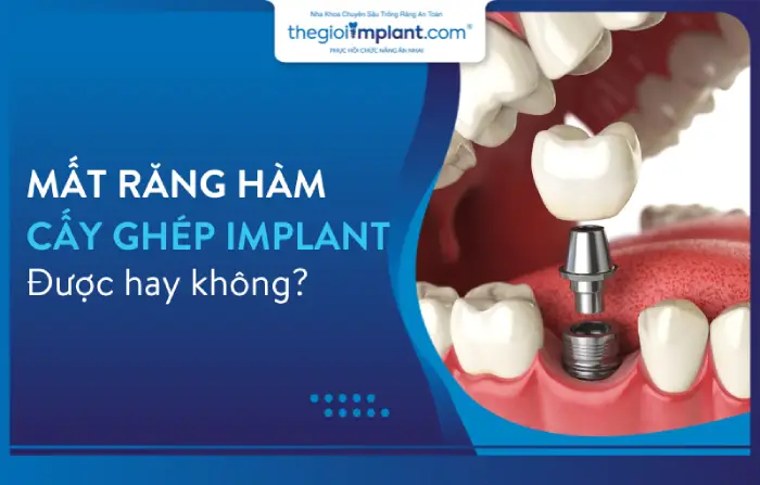 Mất răng hàm có cấy ghép Implant được hay không?