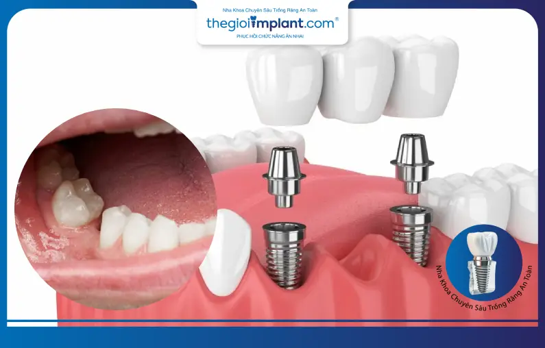 Mất răng hàm có cấy ghép Implant được hay không?