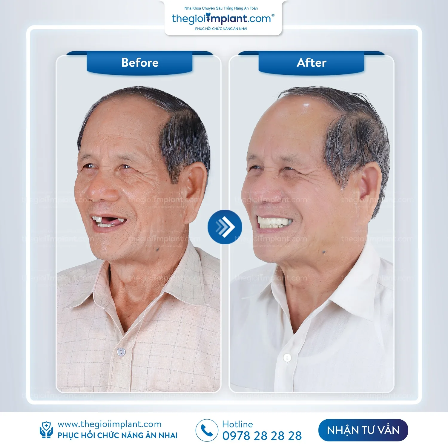 Trồng răng implant giúp mang lại lợi ích lâu dài về sức khỏe và thẩm mỹ