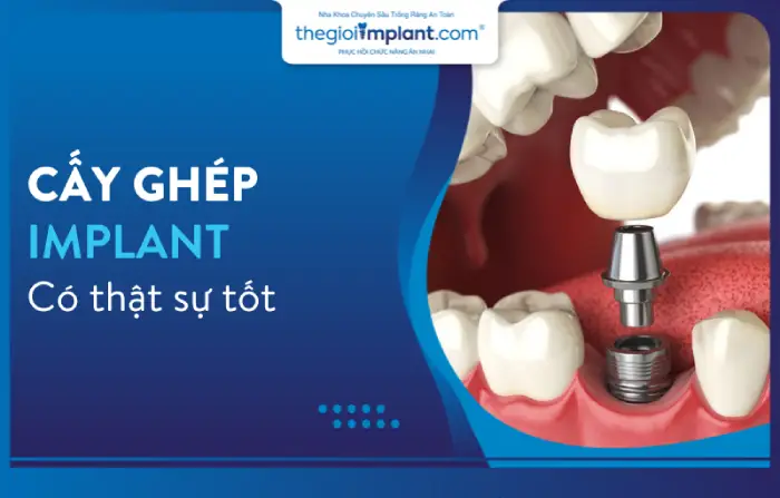 Trồng răng bằng cấy ghép Implant có thật sự tốt