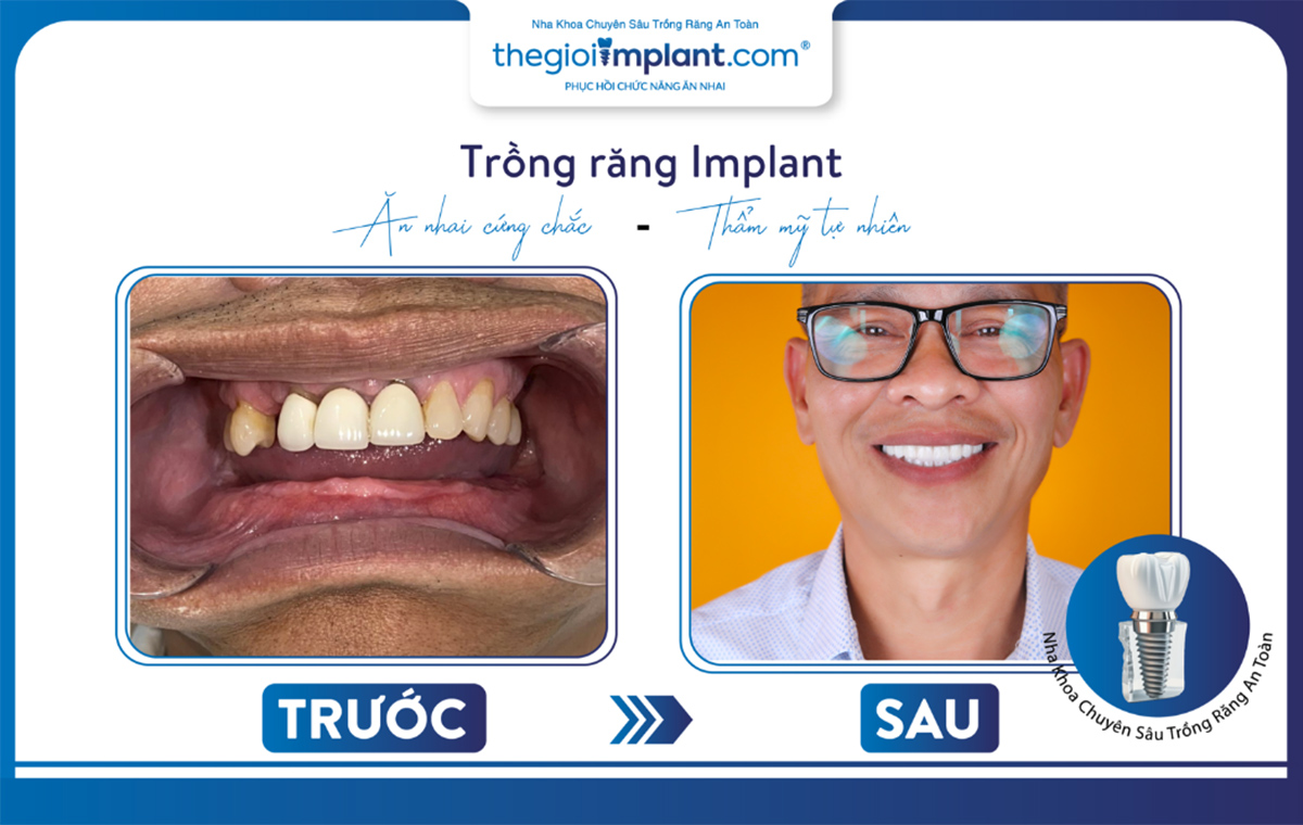 Trồng răng implant mang lại độ thẩm mỹ rất cao