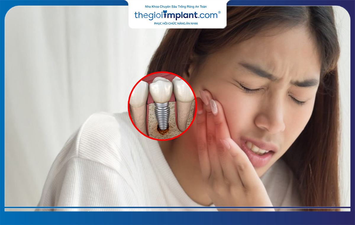 Cấy ghép implant có thể có nguy cơ sưng và nhiễm trùng răng