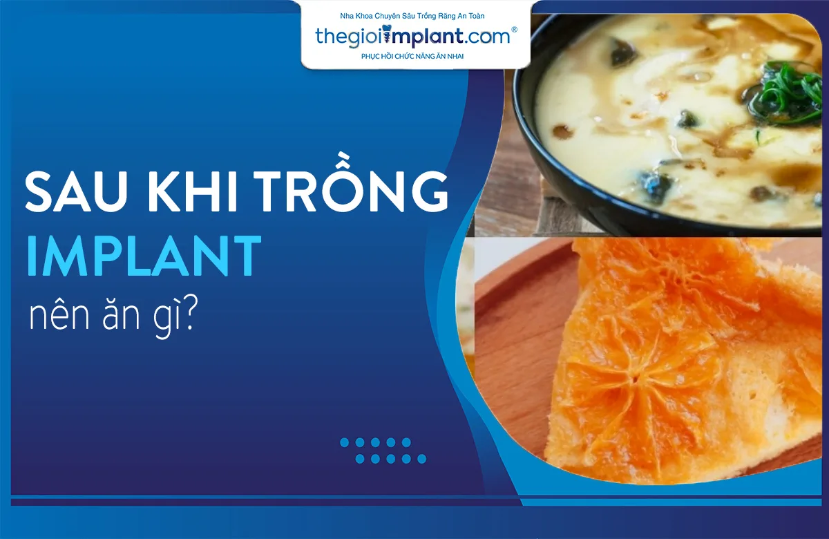 Sau khi trồng răng implant nên ăn gì