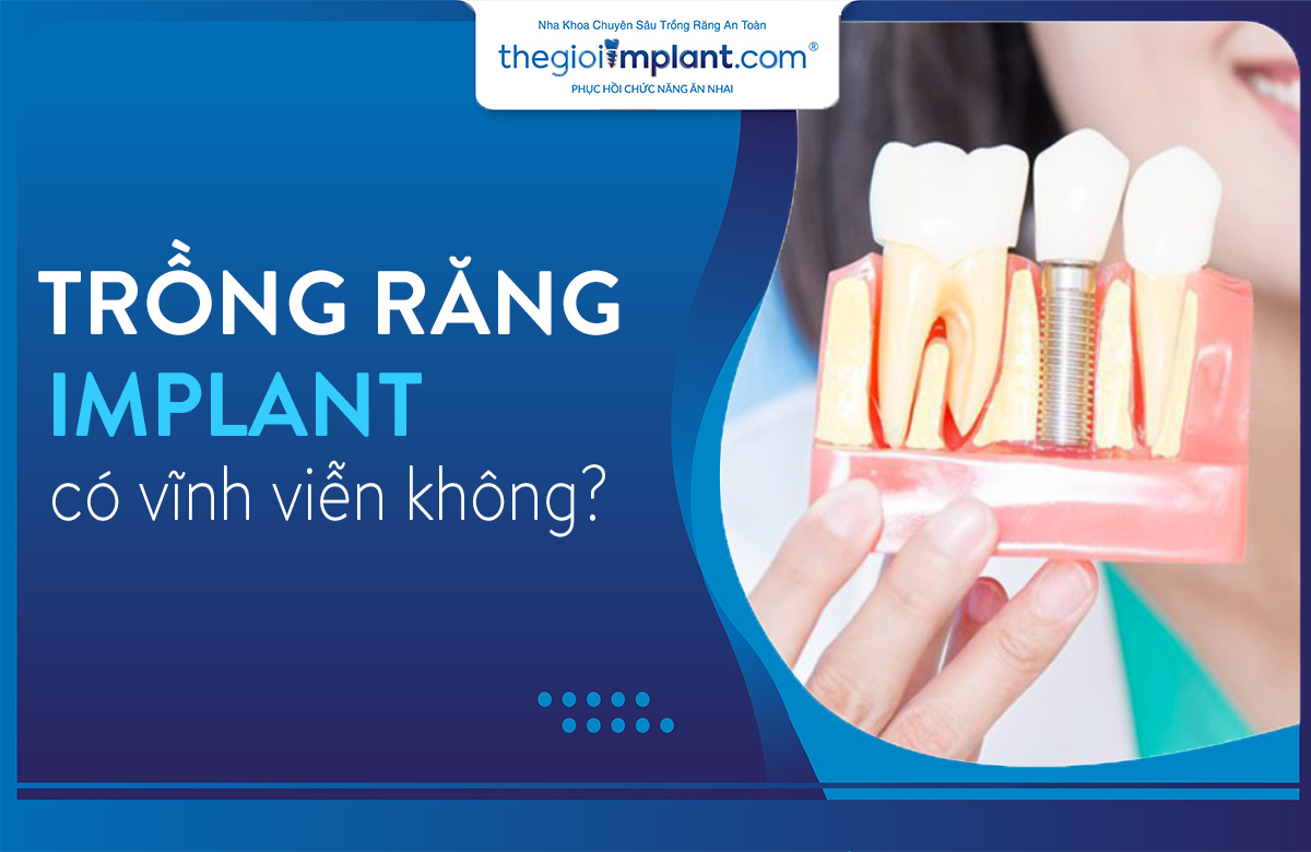 Thumnail trồng răng implant có vĩnh viễn không