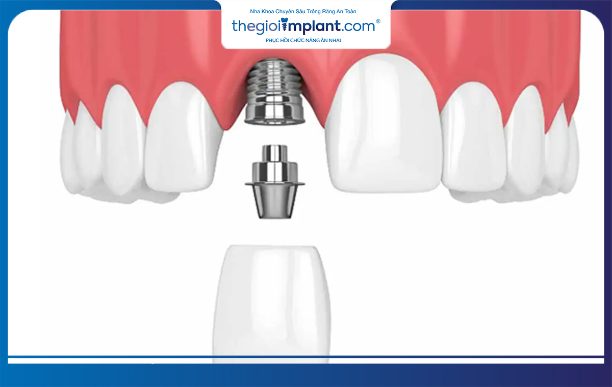 Trồng implant răng cửa 