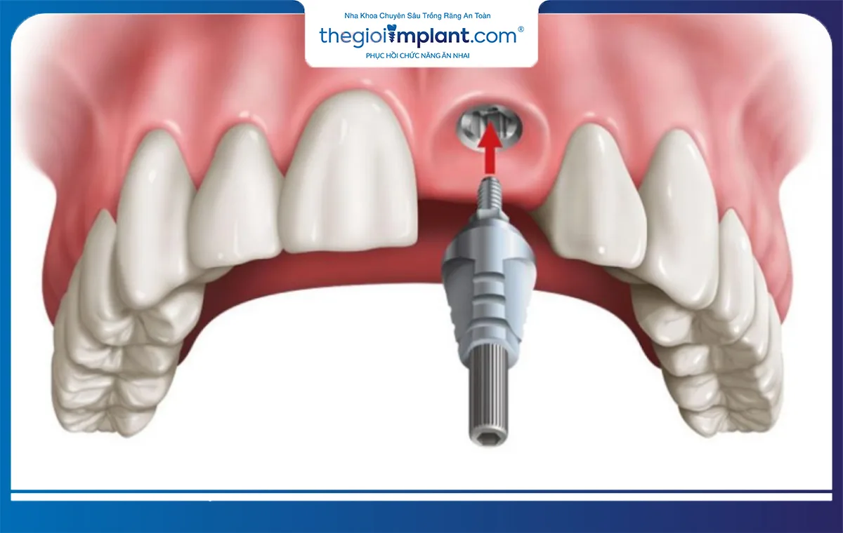 Trồng implant răng cửa là giải pháp chỉnh nha hiện đại và tốt nhất hiện nay