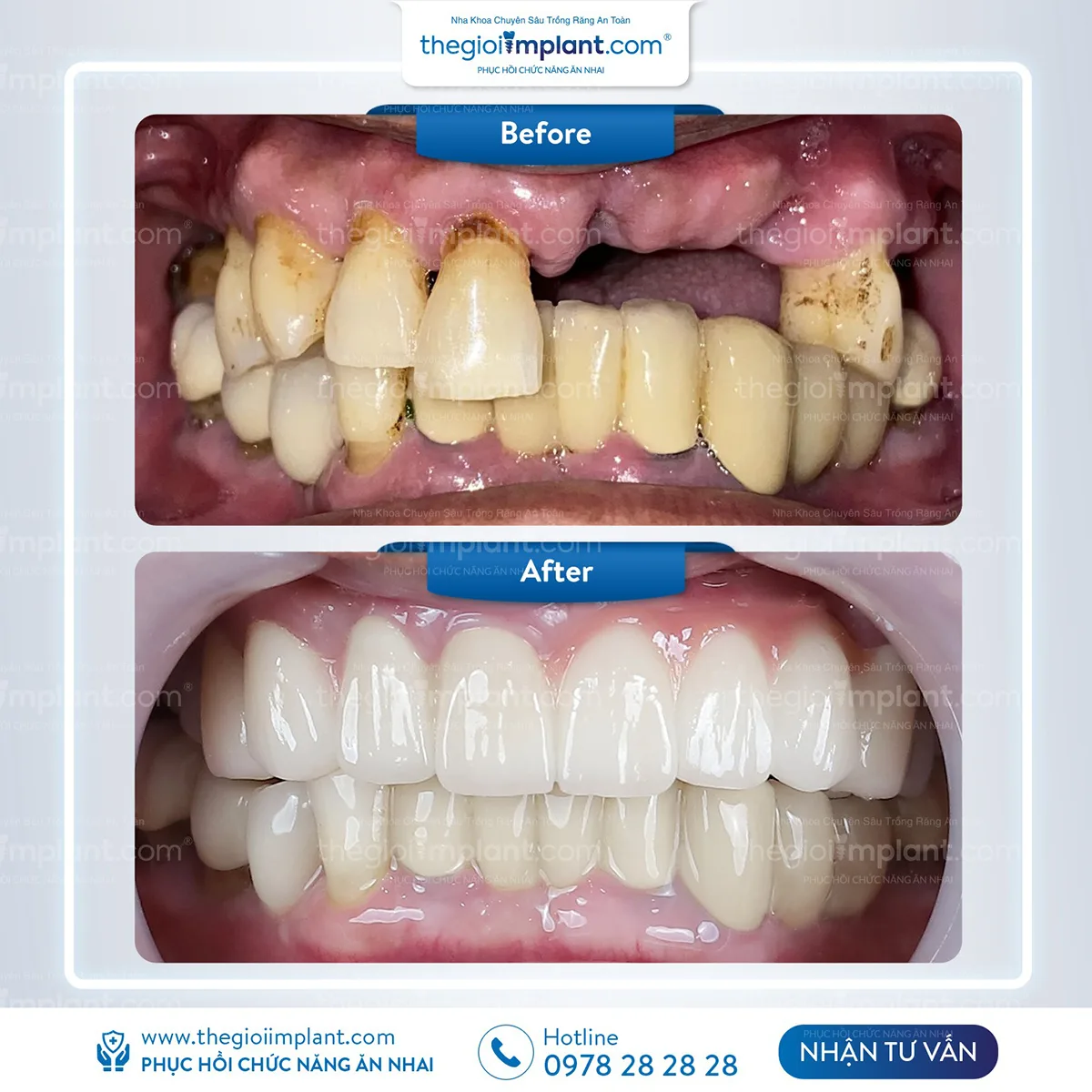 Chi phí trồng implant răng cửa phù hợp với nhiều đối tượng
