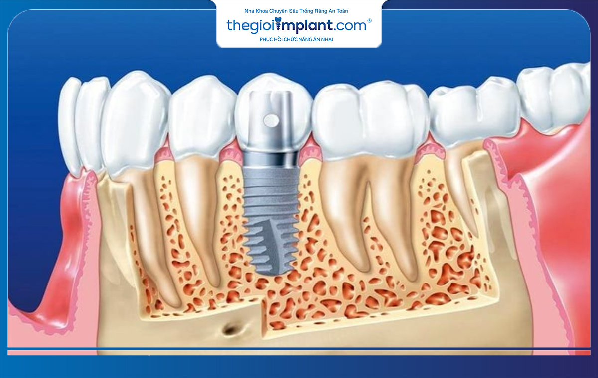 Sưng tại vị trí cắm implant là phản ứng tự nhiên của cơ thể sau phẫu thuật 