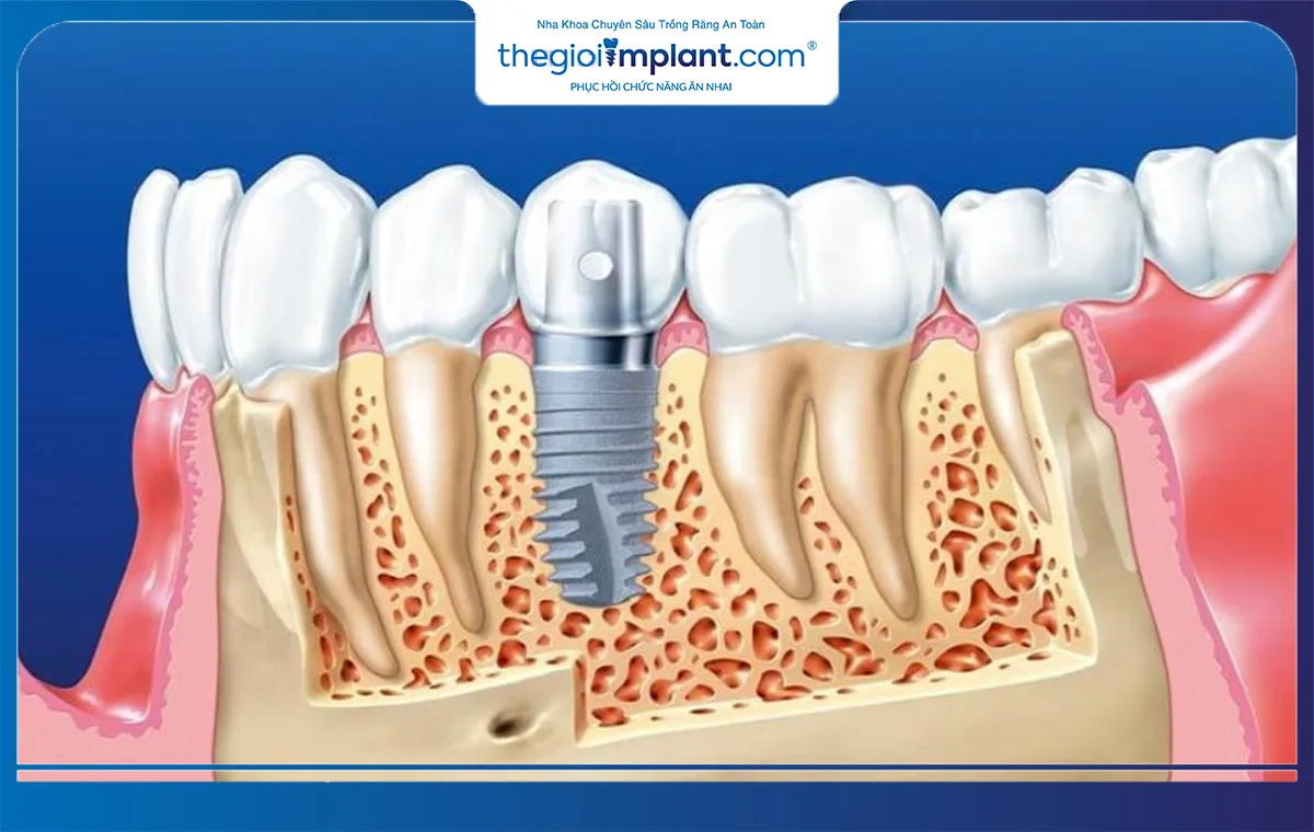 Sưng tại vị trí cắm implant là phản ứng tự nhiên của cơ thể sau phẫu thuật
