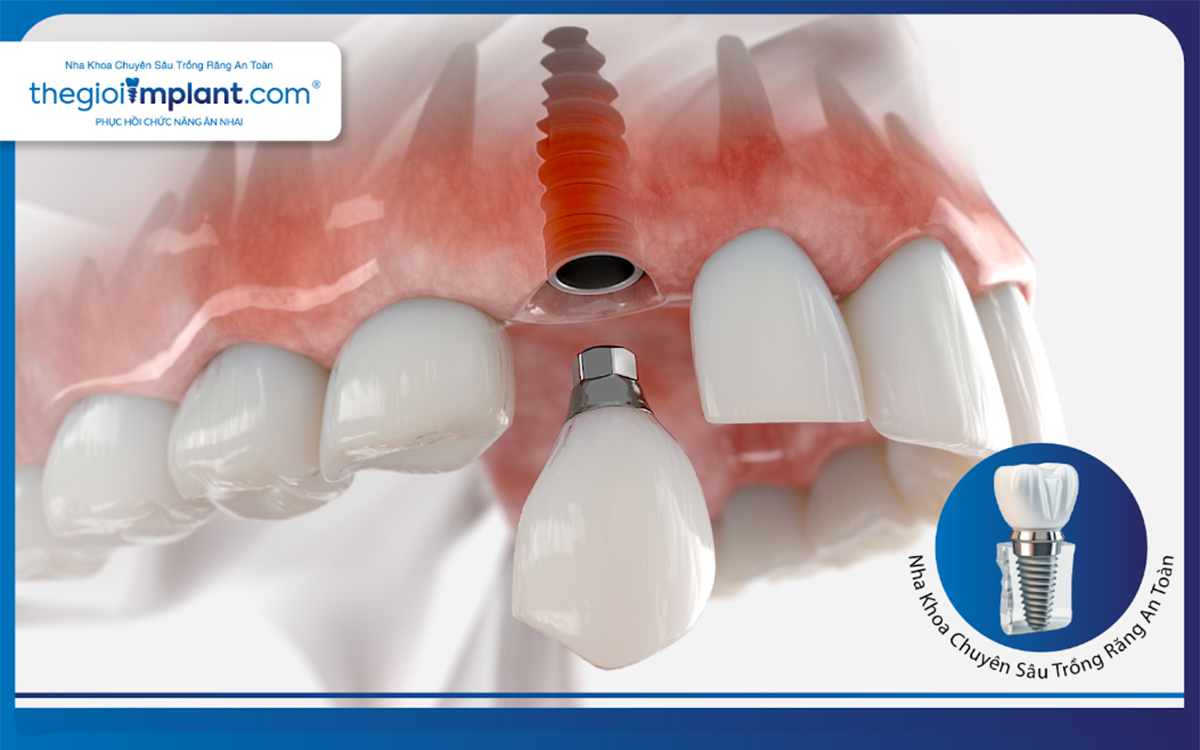 Răng implant có thể sử dụng vĩnh viễn nếu được chăm sóc cẩn thận